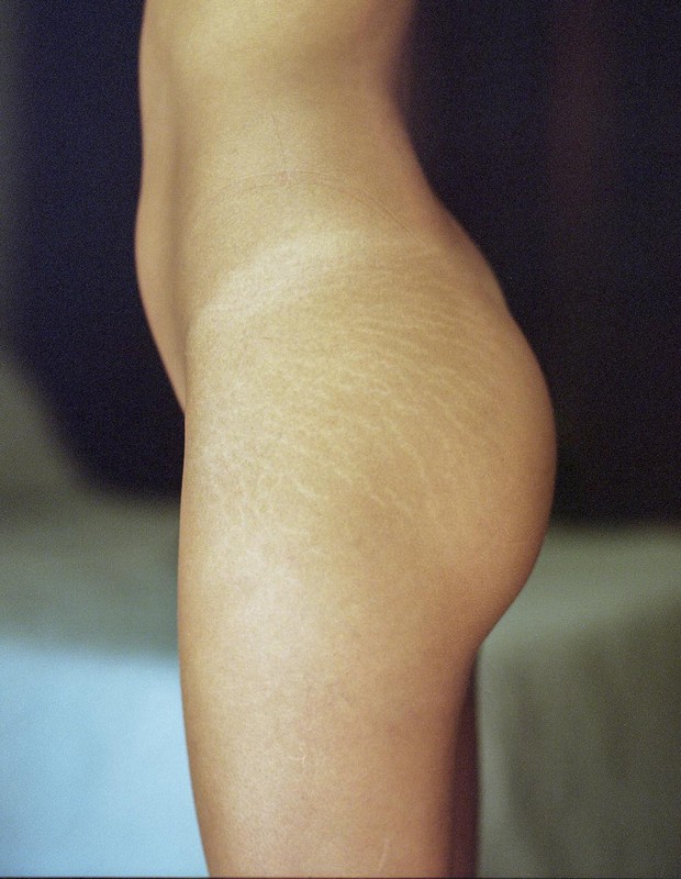 Alice Milagres mostra estrias na web (Foto: Kenny Hsu)